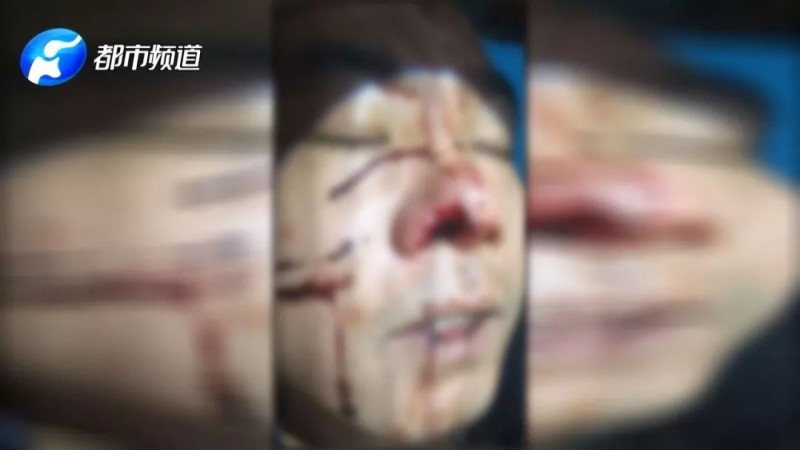 郑州一男子因家中管道堵塞找物业询问却被咬烂鼻子？物业：摔跤时牙齿挂的