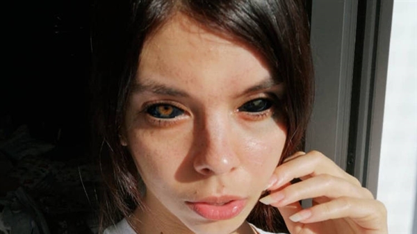 波兰姑娘追求个性将双眼染黑：一只永久失明、一只半残