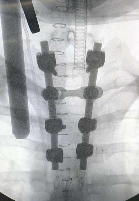 90后男子做俯卧撑致下身瘫痪